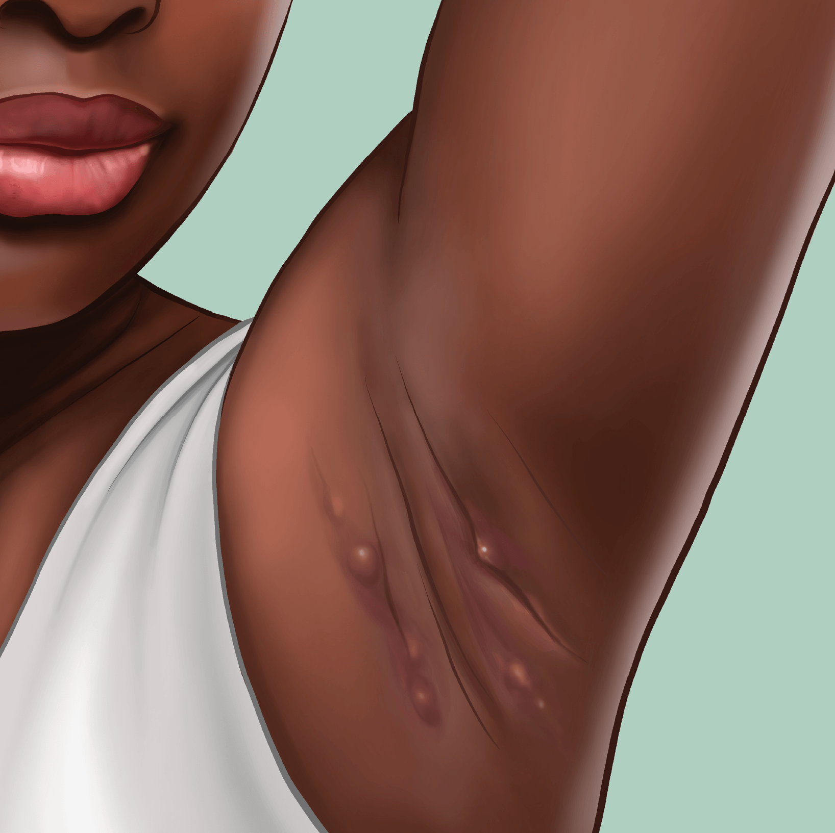 An illustration of a black woman raising her armpit to reveal Hidradenitis Suppurativa drawn by Evyn Caiazza.